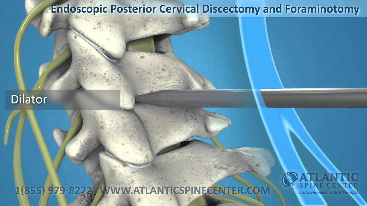 Endoscopic Foraminotomy of the Lumbar and Cervical Spine Atlantic