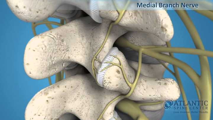 Medial Branch Nerve Block Injections | Atlantic Spine Center