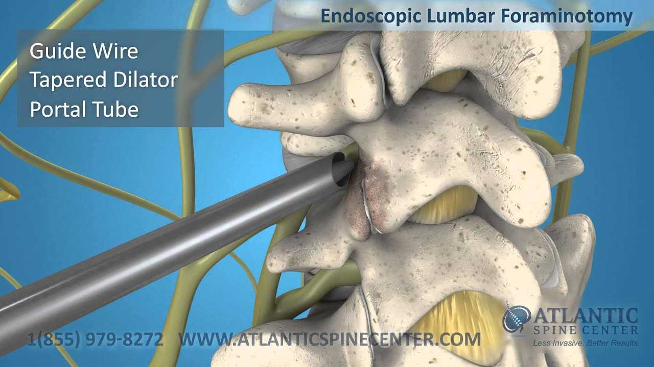 Endoscopic Foraminotomy of the Lumbar and Cervical Spine Atlantic
