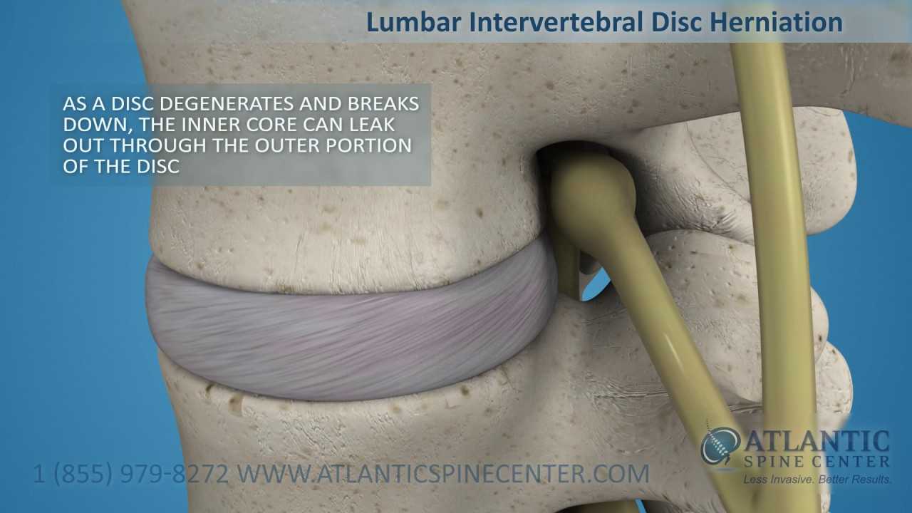 Herniated Disc Causes, Symptoms, Diagnosis and Prevention Atlantic