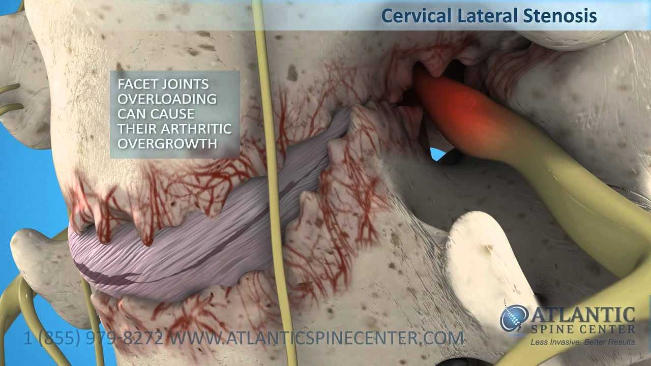 What is a Pinched Nerve? | Atlantic Spine Center